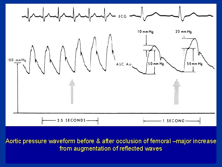 Aortic pressure waveform before & after occlusion of femoral –major increase from augmentation of