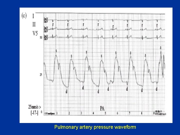 Pulmonary artery pressure waveform 