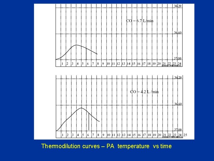 Thermodilution curves – PA temperature vs time 