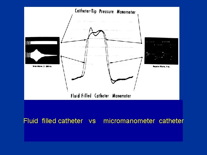 Fluid filled catheter vs micromanometer catheter 