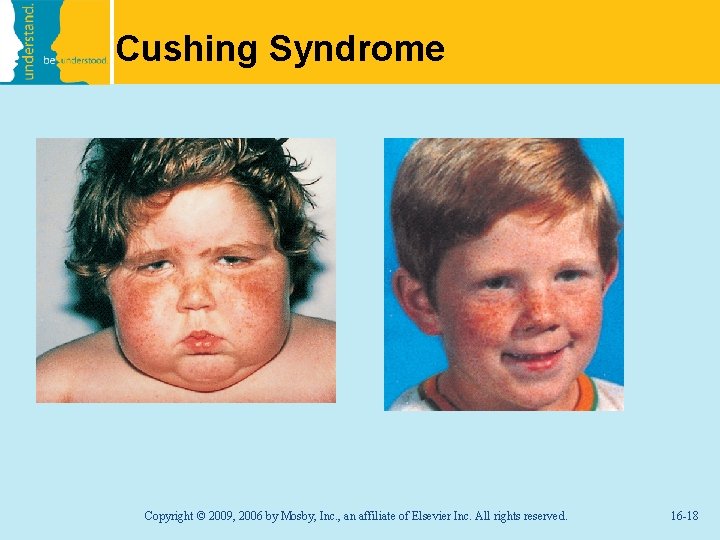 Cushing Syndrome Copyright © 2009, 2006 by Mosby, Inc. , an affiliate of Elsevier