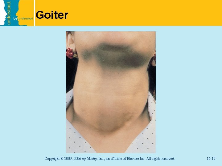 Goiter Copyright © 2009, 2006 by Mosby, Inc. , an affiliate of Elsevier Inc.
