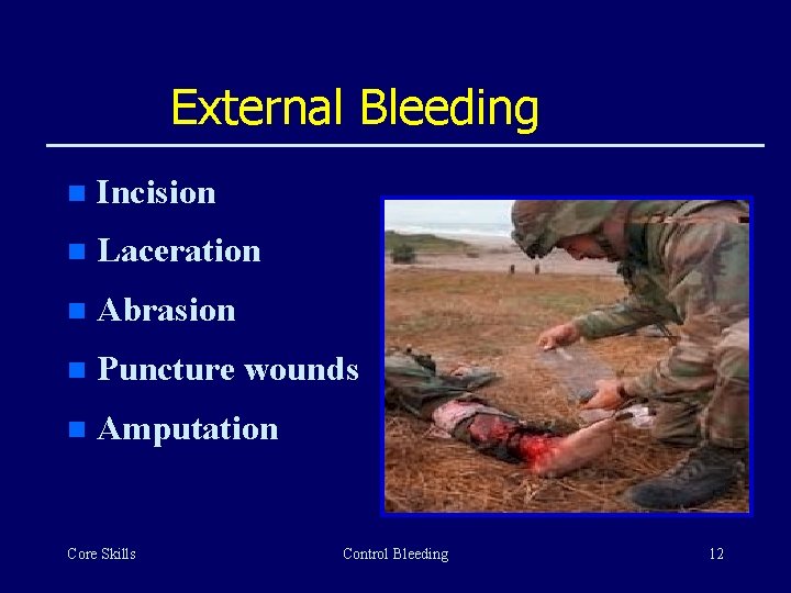 External Bleeding n Incision n Laceration n Abrasion n Puncture wounds n Amputation Core
