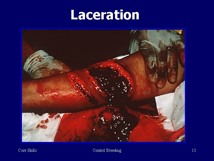 Laceration Core Skills Control Bleeding 13 