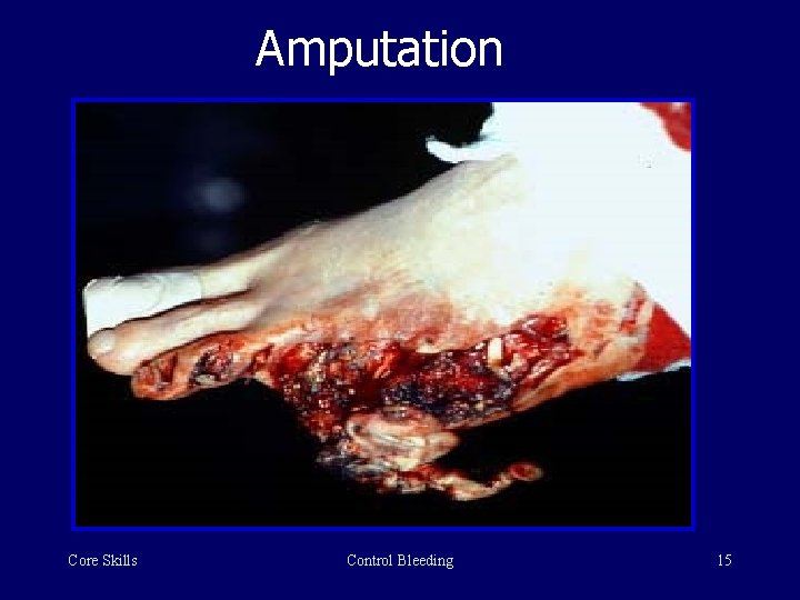 Amputation Core Skills Control Bleeding 15 