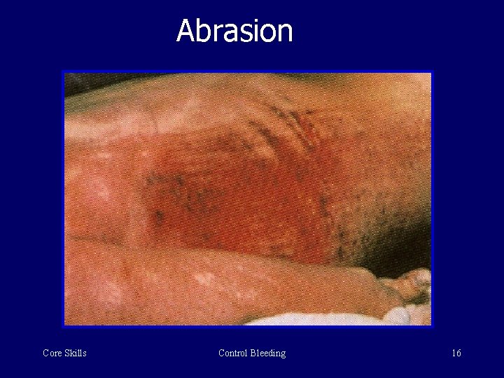 Abrasion Core Skills Control Bleeding 16 