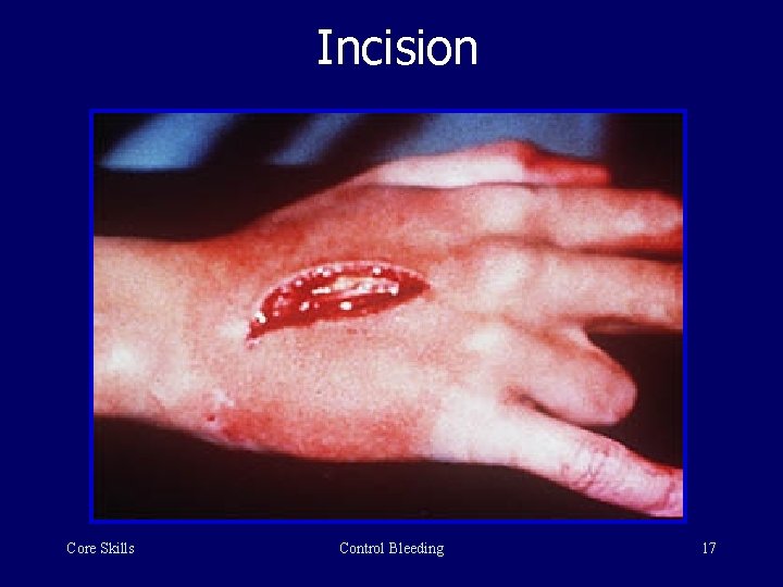 Incision Core Skills Control Bleeding 17 