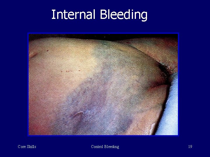 Internal Bleeding Core Skills Control Bleeding 19 