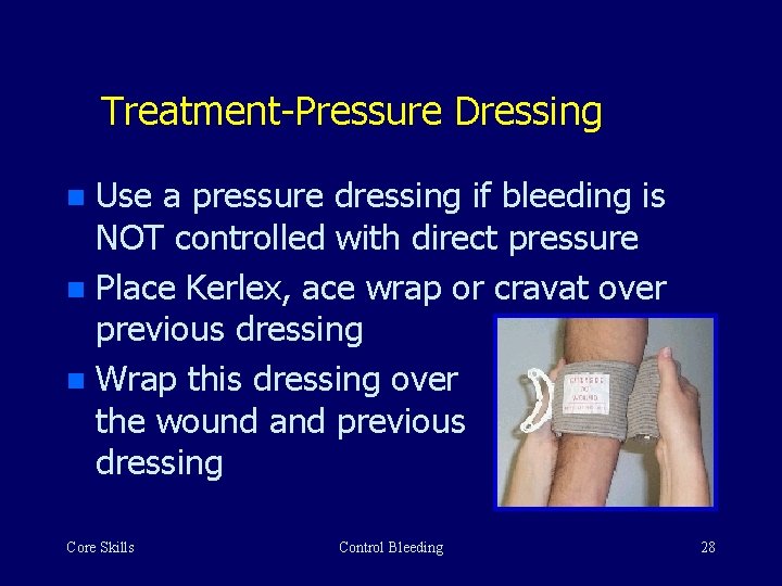 Treatment-Pressure Dressing Use a pressure dressing if bleeding is NOT controlled with direct pressure