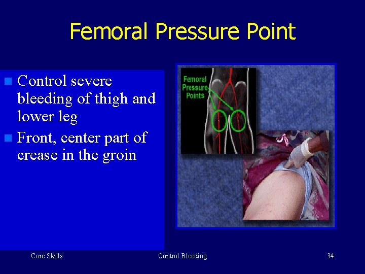 Femoral Pressure Point Control severe bleeding of thigh and lower leg n Front, center