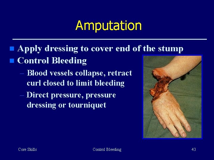 Amputation Apply dressing to cover end of the stump n Control Bleeding n –