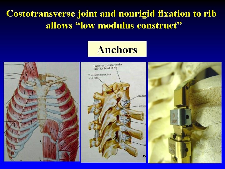 Costotransverse joint and nonrigid fixation to rib allows “low modulus construct” Anchors 