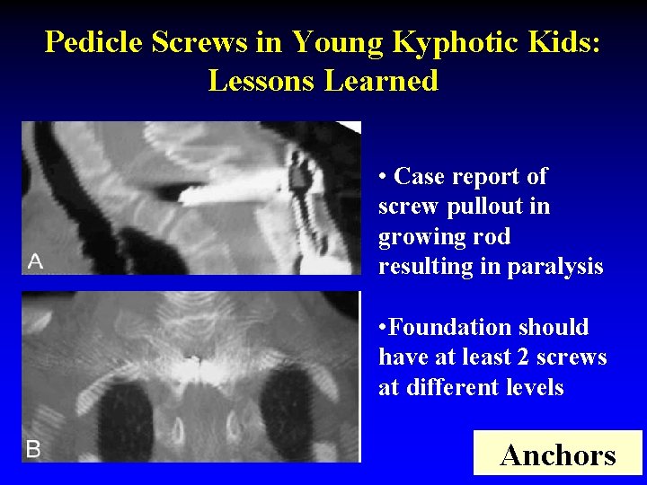 Pedicle Screws in Young Kyphotic Kids: Lessons Learned • Case report of screw pullout