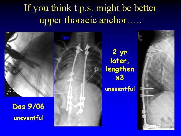 If you think t. p. s. might be better upper thoracic anchor…. . ipo