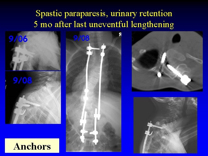 Spastic paraparesis, urinary retention 5 mo after last uneventful lengthening 9/06 9/08 Anchors 9/08