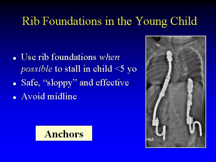 Rib Foundations in the Young Child l l l Use rib foundations when possible