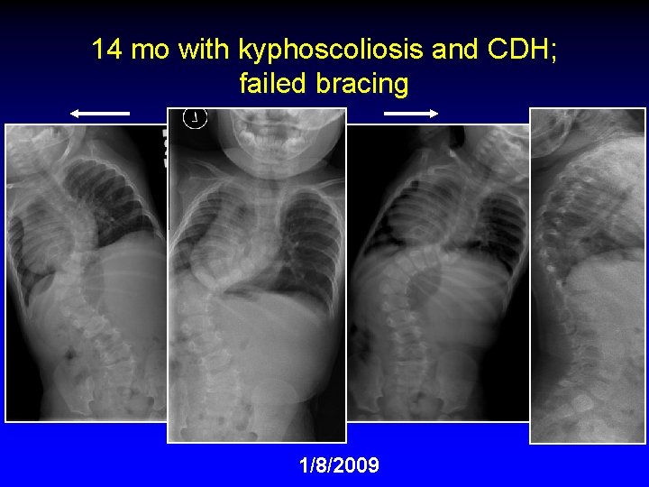 14 mo with kyphoscoliosis and CDH; failed bracing 1/8/2009 