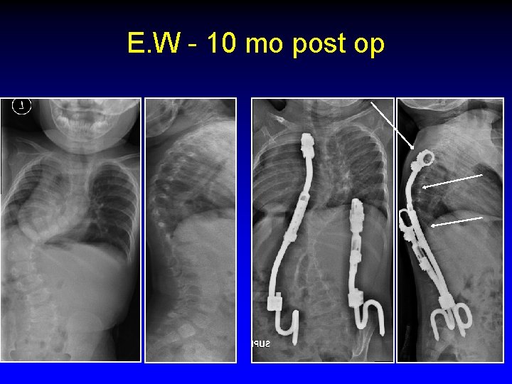 E. W - 10 mo post op 