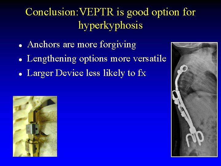 Conclusion: VEPTR is good option for hyperkyphosis l l l Anchors are more forgiving