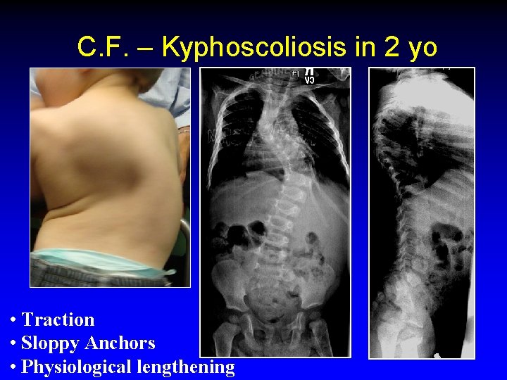 C. F. – Kyphoscoliosis in 2 yo • Traction • Sloppy Anchors • Physiological
