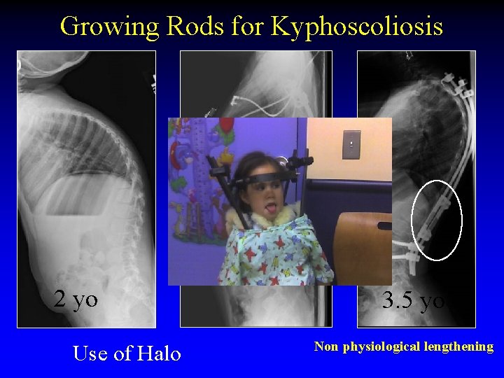 Growing Rods for Kyphoscoliosis 2 yo Use of Halo 3. 5 yo Non physiological
