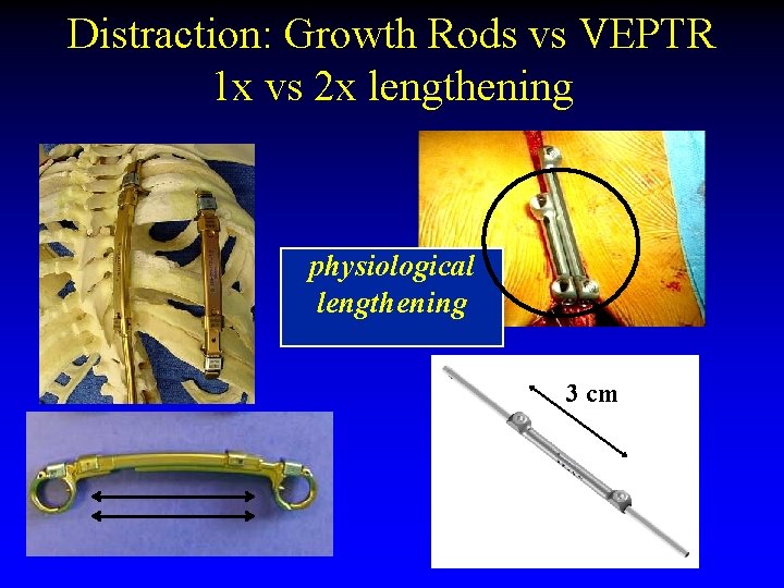 Distraction: Growth Rods vs VEPTR 1 x vs 2 x lengthening physiological lengthening 3