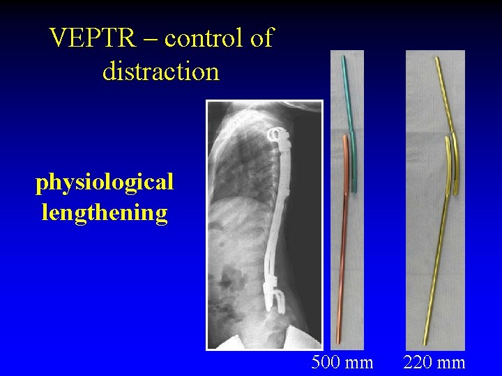 VEPTR – control of distraction physiological lengthening 500 mm 220 mm 