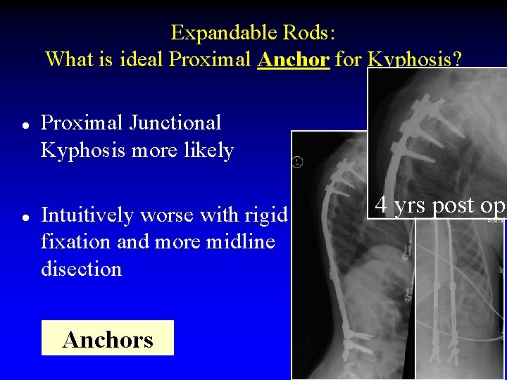 Expandable Rods: What is ideal Proximal Anchor for Kyphosis? l l Proximal Junctional Kyphosis