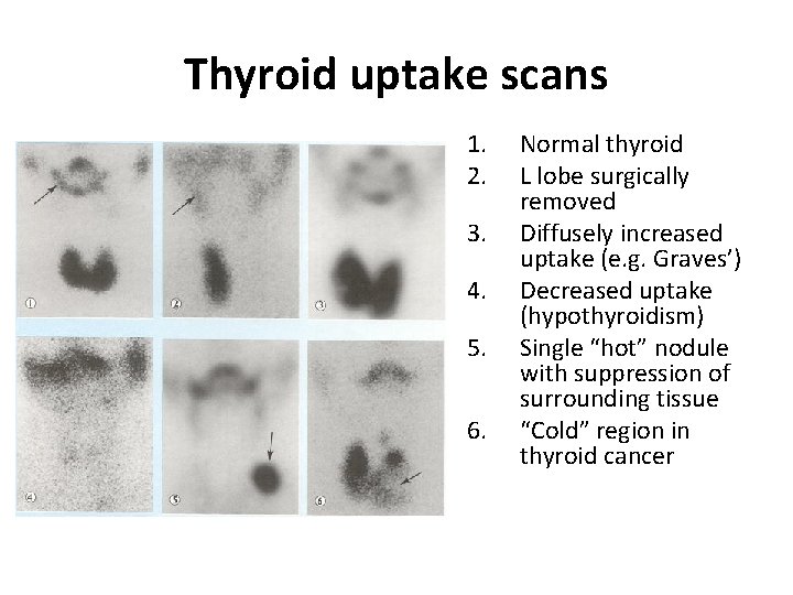 Thyroid uptake scans 1. 2. 3. 4. 5. 6. Normal thyroid L lobe surgically