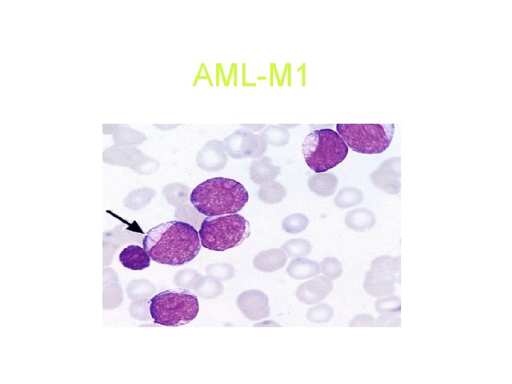 AML-M 1 AML-M 1
