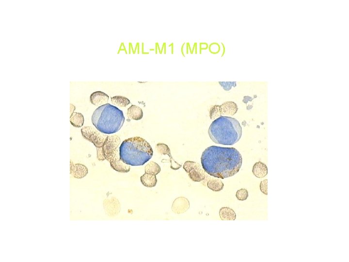 AML-M 1 (MPO) AML-M 1 (MPO)
