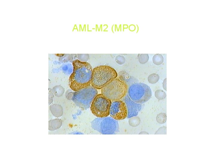 AML-M 2 (MPO) AML-M 2 (MPO)