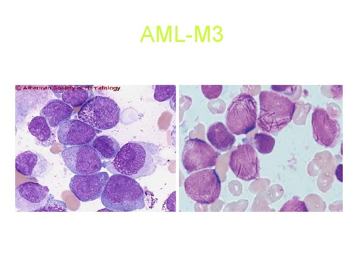 AML-M 3 AML-M 3