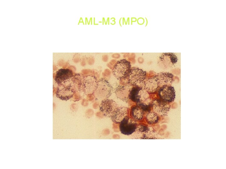 AML-M 3 (MPO) AML-M 3 (MPO)