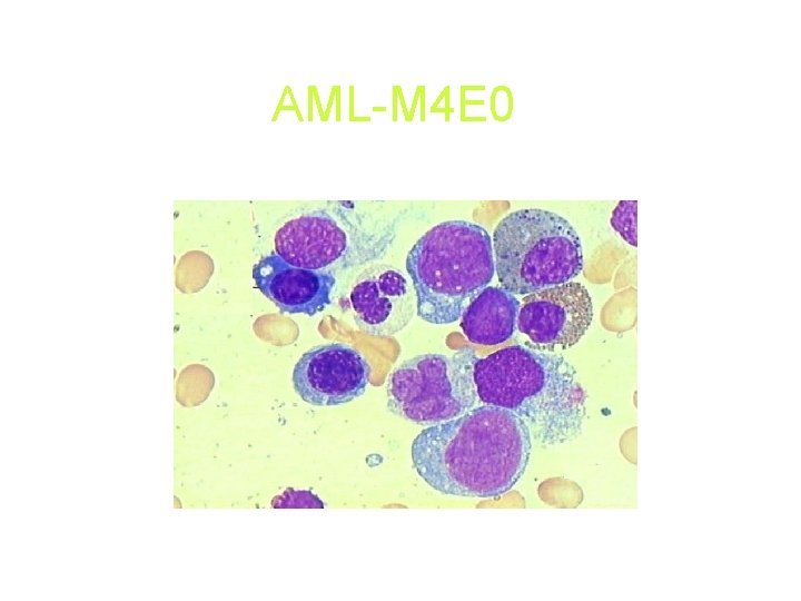 AML-M 4 E 0 AML-M 4 E 0