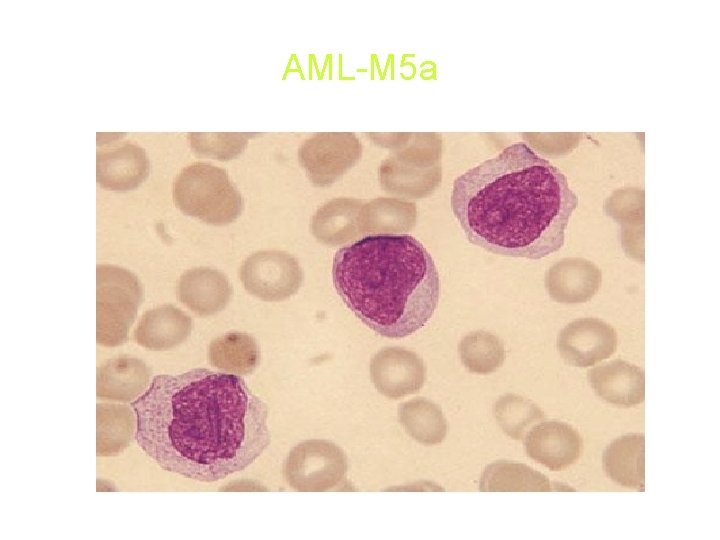 AML-M 5 a AML-M 5 a
