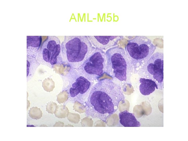 AML-M 5 b AML-M 5 b
