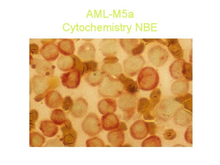AML-M 5 a Cytochemistry NBE AML-M 5 a Cytochemistry NBE