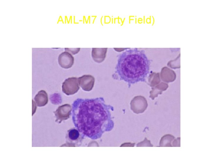 AML-M 7 (Dirty Field) AML-M 7 (Dirty Field)