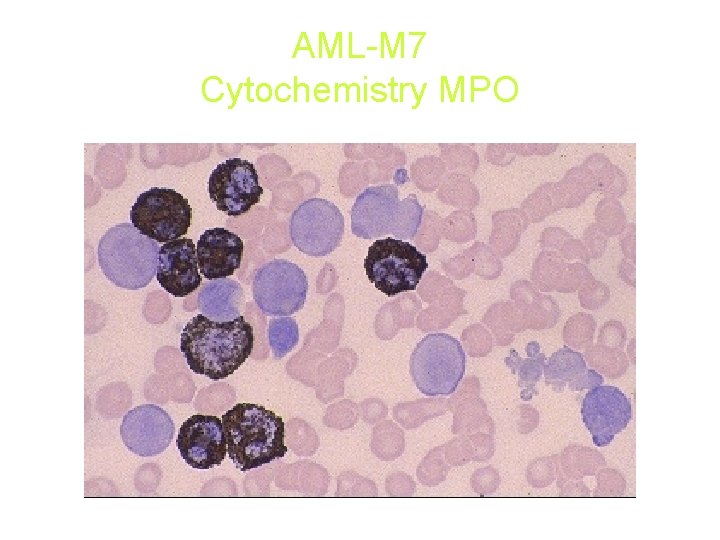 AML-M 7 Cytochemistry MPO AML-M 7 Cytochemistry MPO