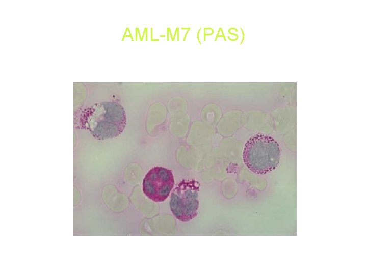 AML-M 7 (PAS) AML-M 7 (PAS)