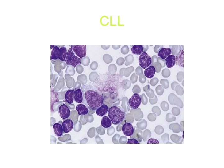 CLL CLL
