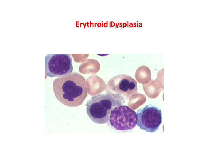 Erythroid Dysplasia Erythroid Dysplasia