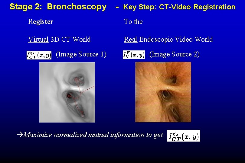 Stage 2: Bronchoscopy - Key Step: CT-Video Registration Register To the Virtual 3 D