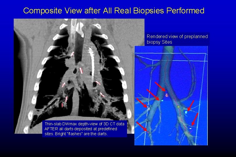 Composite View after All Real Biopsies Performed Rendered view of preplanned biopsy Sites Thin-slab