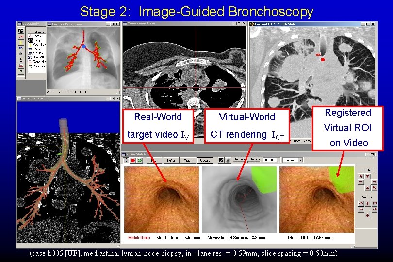 Stage 2: Image-Guided Bronchoscopy Real-World Virtual-World target video IV CT rendering ICT Registered Virtual