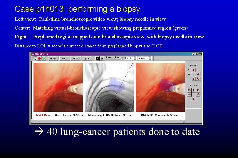 Case p 1 h 013: performing a biopsy Left view: Real-time bronchoscopic video view;