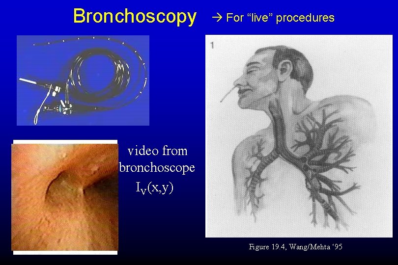 Bronchoscopy For “live” procedures video from bronchoscope IV(x, y) Figure 19. 4, Wang/Mehta ‘