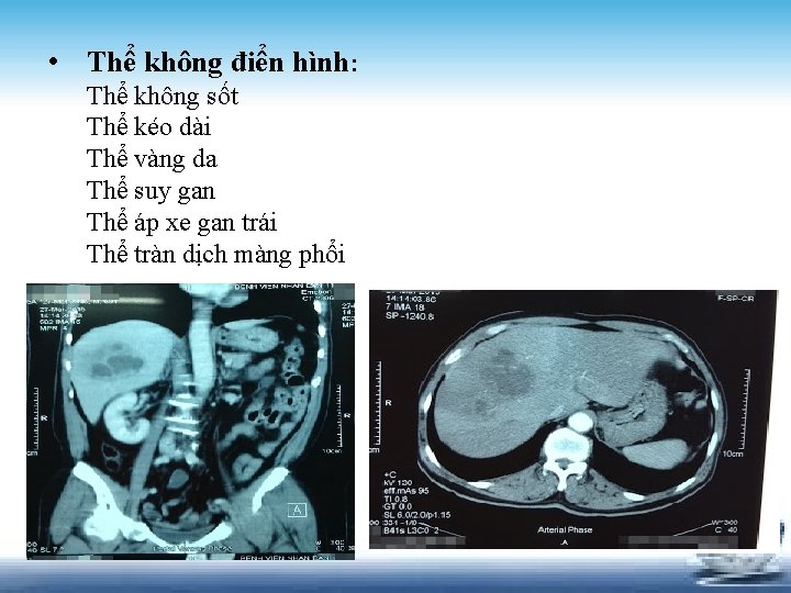  • Thể không điển hình: Thể không sốt Thể kéo dài Thể vàng