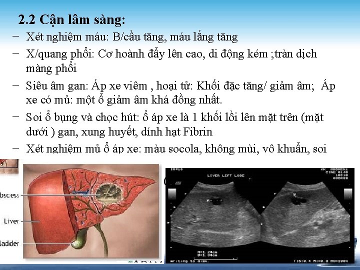 2. 2 Cận lâm sàng: − Xét nghiệm máu: B/cầu tăng, máu lắng tăng